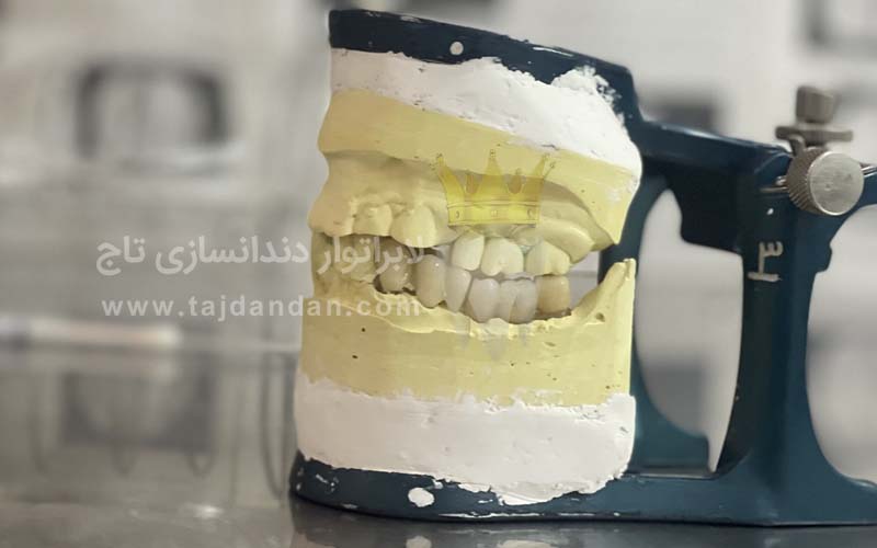 قالب گیری دندان توسط دندانسازی تاج
